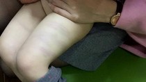Học sinh 3 tuổi trường Ngọc Sơn bị đánh bầm tím ở lớp học ảnh 1