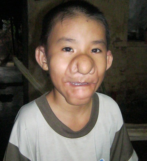 Cậu bé <b>Bùi Nhật Minh</b> Tiến( sinh năm 2000). Khi mới hai tuổi, trên hai vành ... - can-benh-la-giaoduc.net.vn.3jpg