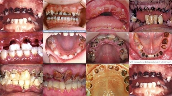 Sâu chân răng là gì Nguyên nhân và cách điều trị