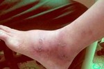 Nguyên nhân và cách phòng tránh bệnh phù nề chân