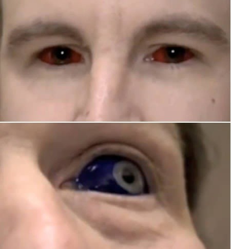 Màu mắt sẽ được thay đổi trong tích tắc nhờ công nghệ xăm tròng mắt