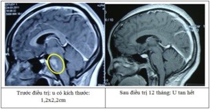 Kỹ thuật sử dụng dao gamma quay là kỹ thuật xạ phẫu tiên tiến trên thế giới, đưa Việt Nam trở thành một trong những nước đầu tiên trong trị u não