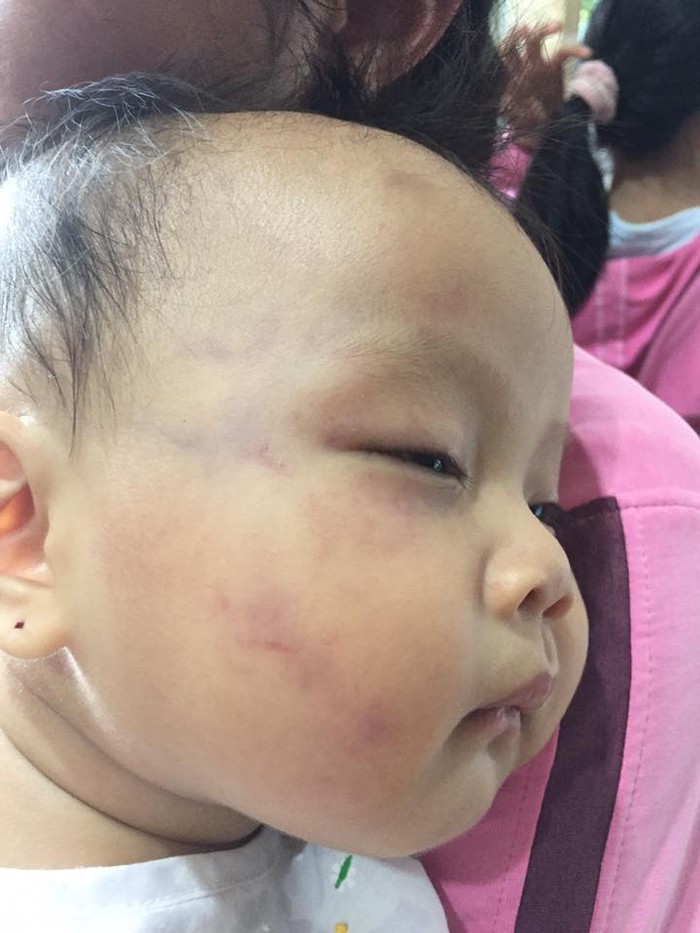 Vùng má phải, trán và mắt của bé Châu Nhã Uyên (8 tháng tuổi) bị bầm, sưng tím. Ảnh: Phan Tuyết