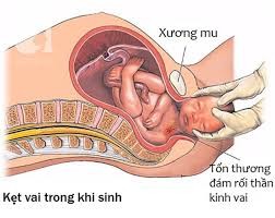 Trẻ bị kẹt vai trong khi sinh. (Ảnh: Báo Sức khỏe và Đời sống)