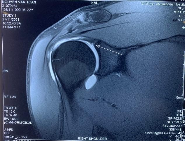 Phim MRI khi có tiêm thuốc thấy rõ tổn thương hơn