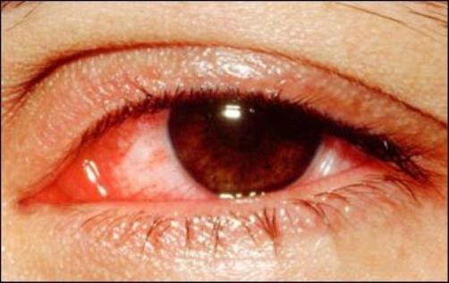 Bệnh đau mắt đỏ: Bể bơi là nơi bệnh đau mắt đỏ dễ lây lan nhất. Để phòng bệnh, khi đi bơi, nên đeo kính bảo vệ, sau khi bơi cần nhỏ mắt bằng nước muối sinh lý Nacl 0,9 % (có bán ở các nhà thuốc). Xem thêm: Bí quyết "nhỏ", giữ sức khỏe "lớn" trong mùa nắng nóng