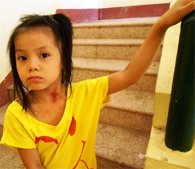 Bệnh lạ xuất hiện trên vùng cổ của một em bé tại khu tái định cư phường Hương Sơ (TP.Huế)