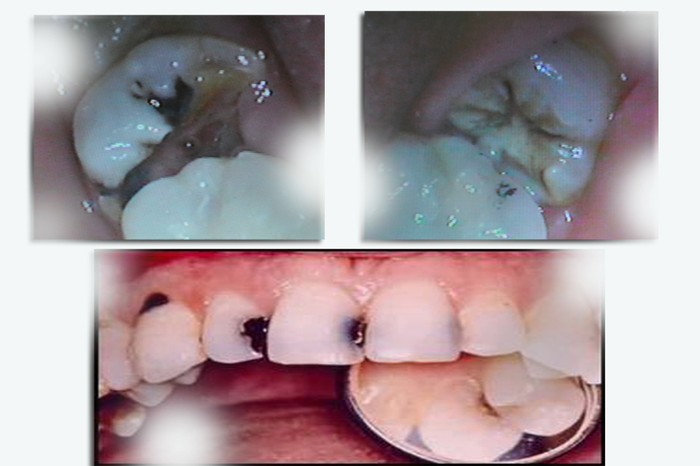 Sâu răng là lý do đầu tiên “bén rễ” vào tuỷ? Bị vỡ, nứt hoặc các loại chấn thương ở răng cũng có thể gây ảnh hưởng đến tủy răng. Có rất nhiều trường hợp nghiến răng nhiều cũng gây chấn thương và cần điều trị tuỷ răng.