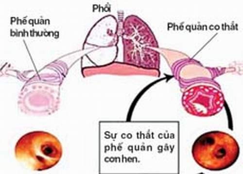 Những yếu tố làm khởi phát cơn hen phế quản.