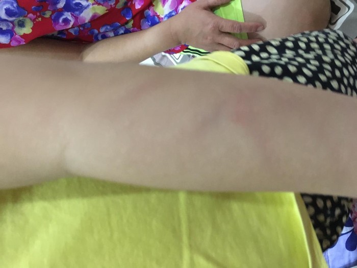 Vết trầy xướt trên tay của học sinh do bị cô giáo bạo hành. (Ảnh: Gia đình nạn nhân cung cấp)