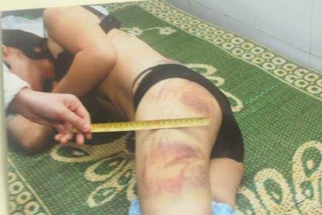 Những vết thương trên người của Lê Thị Lý được chụp hình lại.