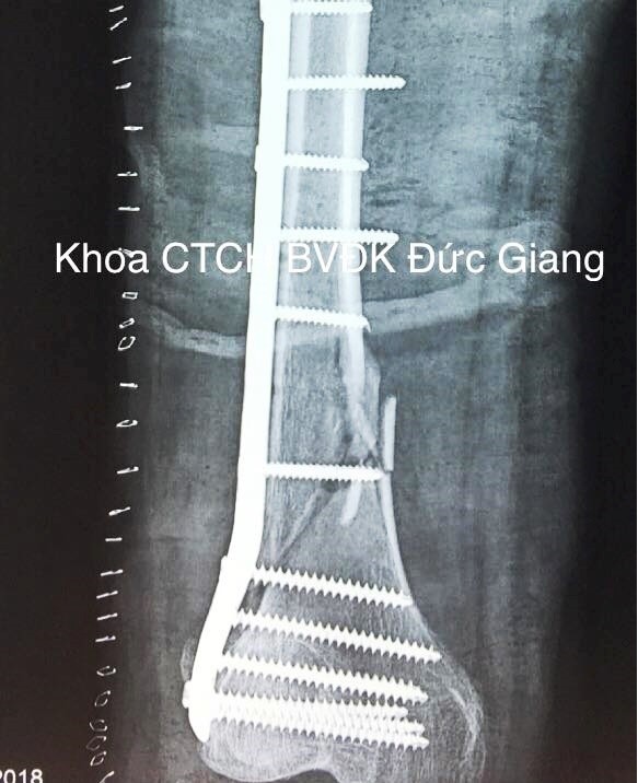 Phim chụp cho thấy tổn thương của bệnh nhân (Ảnh: Bệnh viện đa khoa Đức Giang)