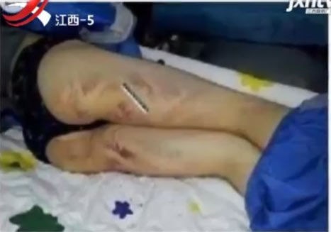 Kênh truyền hình Giang Tây 5 đưa hình ảnh một nữ sinh sau khi bị đánh, ảnh do gia đình nạn nhân cung cấp.