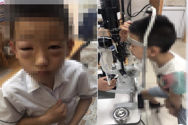 Hình ảnh con anh C. bị sưng phù mắt. (Ảnh: NVCC) tieu-hoc-hai-boi.jpg