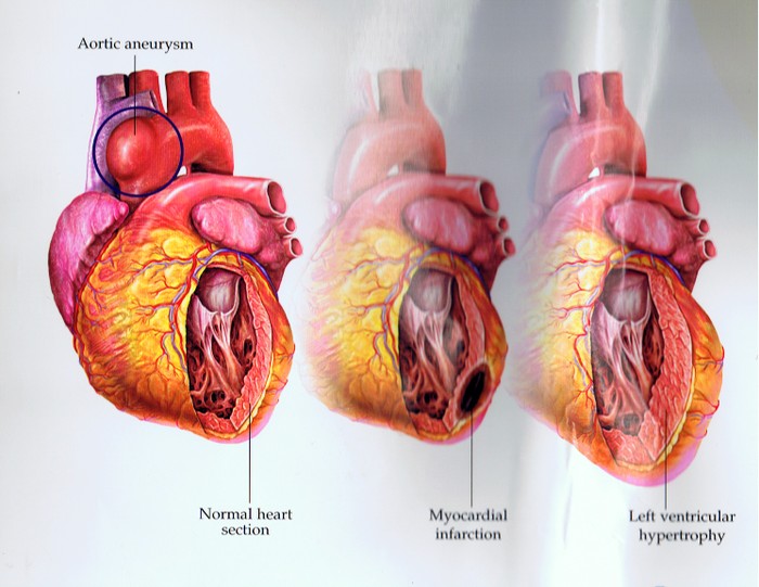 Cao huyết áp (cao máu) gây ra nhiều vấn đề về tim mạch