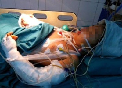 Nạn nhân Bích hiện đang được chữa trị tại bệnh viện Việt Đức