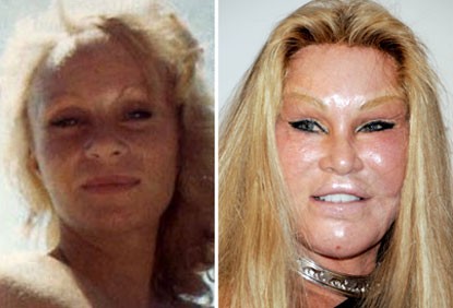 Nhà hoạt động xã hội Jocelyn Wildenstein cũng bị biến thành "quái nhân" vì công nghệ phẫu thuật thẩm mỹ. Cô đã chỉnh sửa mặt hàng trăm lần để trông giống mặt mèo.