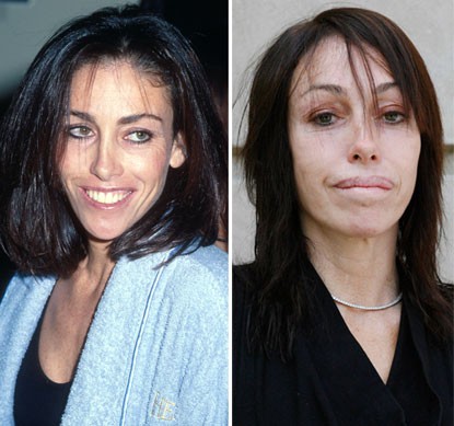 Heidi Fleiss, ngôi sao truyền hình thực tế của Mỹ, ngày càng tàn tạ sau nhiều lần tu bổ nhan sắc.