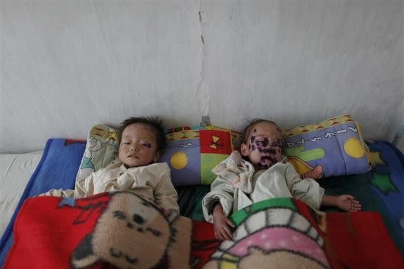 Trẻ em Triều Tiên mắc bệnh suy dinh dưỡng tại bệnh viện ở Haeju ngày 1/10/2011.