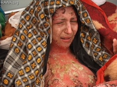 Gulbar, một phụ nữ Afghanistan sau khi bị chồng ngược đãi tháng 10/2005.