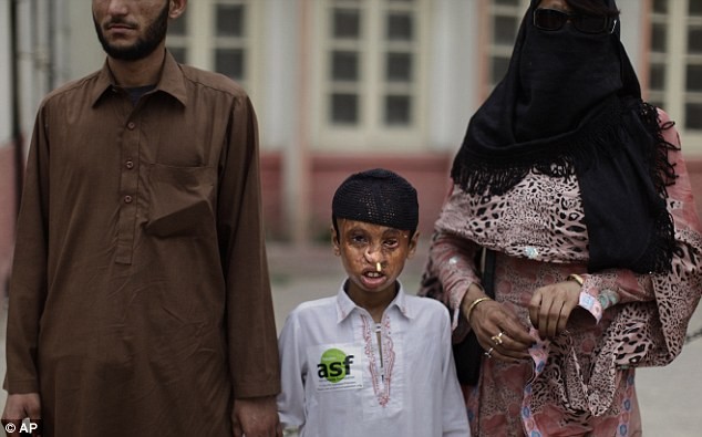 Akhtar Yar, 9 tuổi, nắm bàn tay của anh trai Rukhan 23 tuổi và Zafar Iqbal, 23 tuổi (phải). Akhtar bị tấn công bằng a-xít năm 2003, Zafar bị tấn công năm 2004.