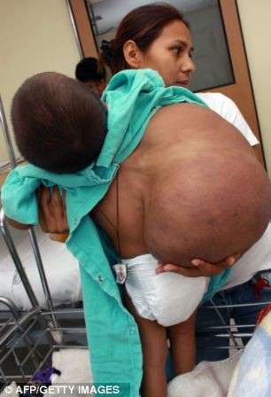 Tiến sĩ Gustavo Hernandez, trưởng khoa nhi của bệnh viện La Raza cho biết, khối u có trọng lượng lớn hơn cả trọng lượng cơ thể của cậu bé Jesus.