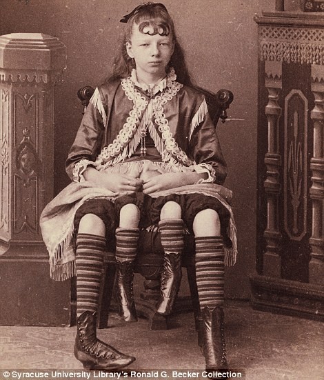 Myrtle Corbin - cô gái có 4 chân và 2 cơ quan sinh dục.