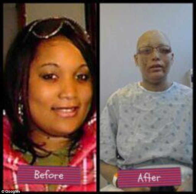 Shanyna Isom trước và sau khi mắc bệnh lạ.
