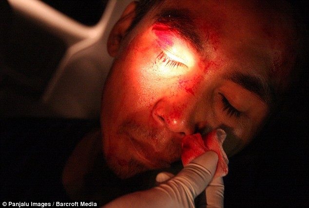 Khuôn mặt đẫm máu của một đấu sĩ đang được các bác sĩ chăm sóc.