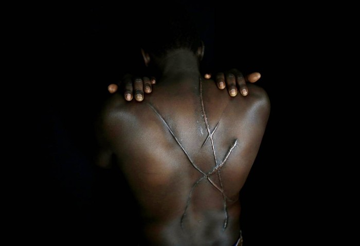 Hassan Mekki, một người nhập cư gốc Sudan 32 tuổi cho xem những vết sẹo trên lưng ở Athens, Hy Lạp ngày 5/12. Người đàn ông chạy trốn xung đột tại Sudan đã bị một nhóm người phân biệt chủng tộc tấn công hồi tháng 8/2012, khoảng 5 tháng sau khi anh tới Hy Lạp, và để lại những vết sẹo này trên lưng.