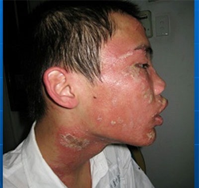 Với tổn thương do do viêm da tiếp xúc như thế này, người bệnh rất đau đớn, ngứa ngáy, khó chịu. vùng tổn thương sâu phỏng mủ dễ nhiễm trùng và cũng có thể để lại sẹo. Ảnh: BS cung cấp