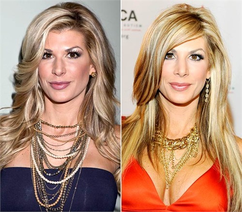 Alexis Bellino. Ngôi sao của Real Housewives of Orange County đi nâng mũi hồi tháng 10. Cô chia sẻ: "Không nhiều người biết tôi đã đi làm mũi. Họ biết tôi có gì đó mới nhưng không thể nghĩ ra đó là gì. Việc nâng mũi khiến gương mặt tôi mềm mại hơn nhiều".