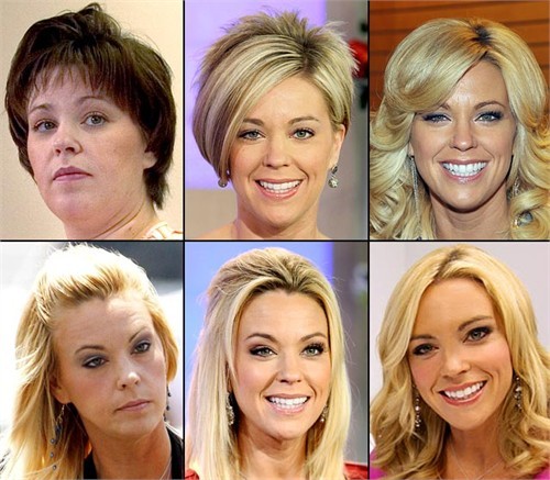 Kate Gosselin. Một chuyên gia phẫu thuật thẩm mỹ nổi tiếng ở New York tiết lộ cùng tờ Us Weekly rằng mỗi khi nhìn mặt của bà mẹ tám con, ông đều nghĩ tới việc đắp một gương mặt hoàn toàn khác vào con người cũ. Nhưng chính Gosselin lại phủ nhận tất cả: "Tôi có cách nghỉ ngơi để duy trì sự trẻ trung. Đơn giản thế thôi"