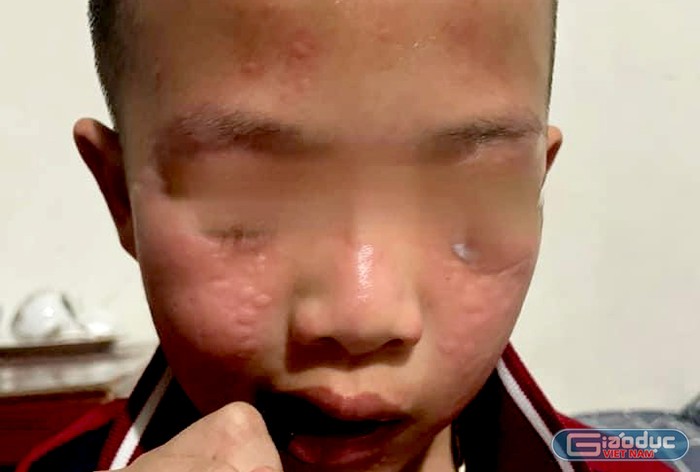 Học sinh bị nổi mề đay trên mặt. (Ảnh: NVCC) gdvn_th-hai-boi (2).jpg